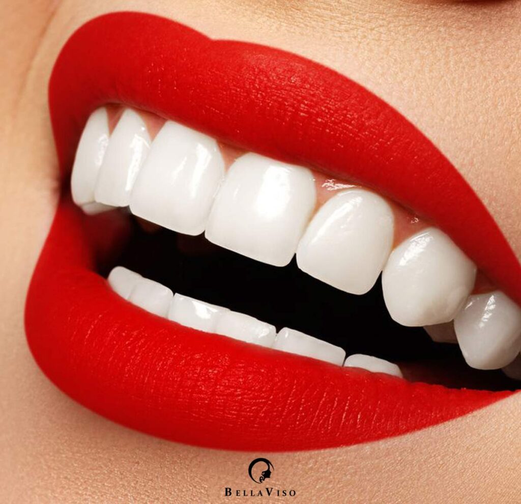 Dental Veneers in Dubai