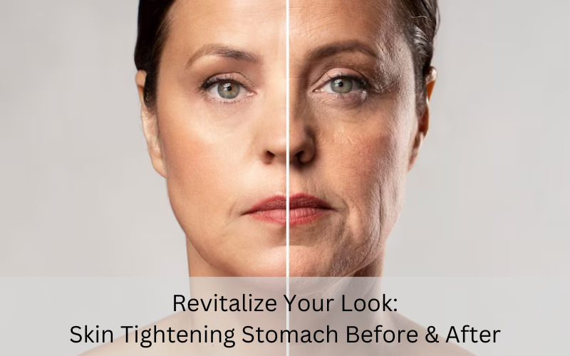 Skin tightening stomach before and after