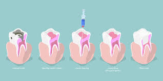 Root Canal Therapy